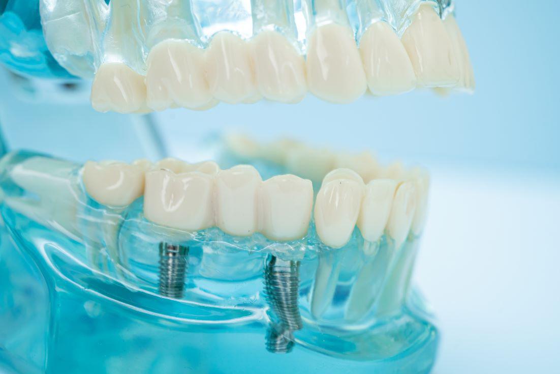 Dental Implants San Rafael, CA