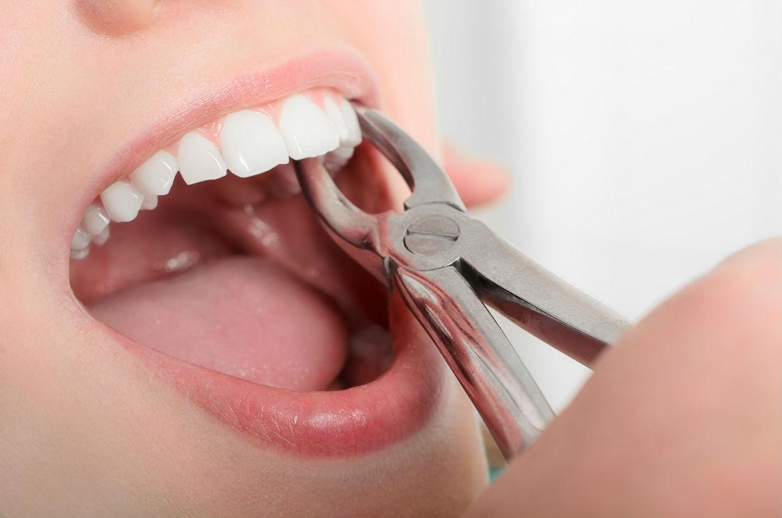 Tooth Extraction San Rafael, CA